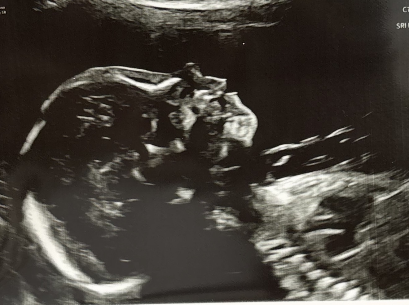 Baby ultrasound provided by the family